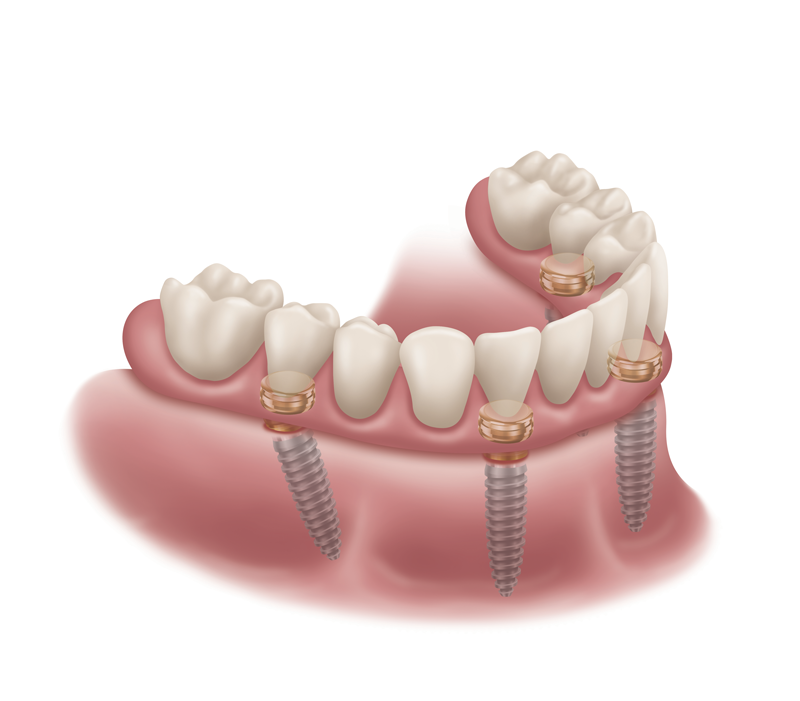 Locator Fixed - Denture Seated